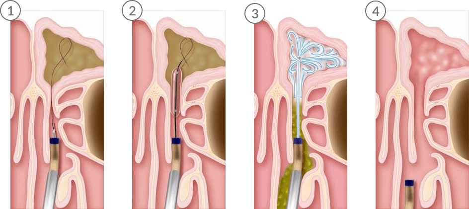 Balloon Sinuplasty steps