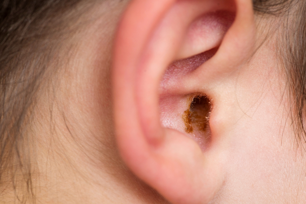Earwax,In,The,Dirty,Ear,Of,A,Child ,Hole,Ear