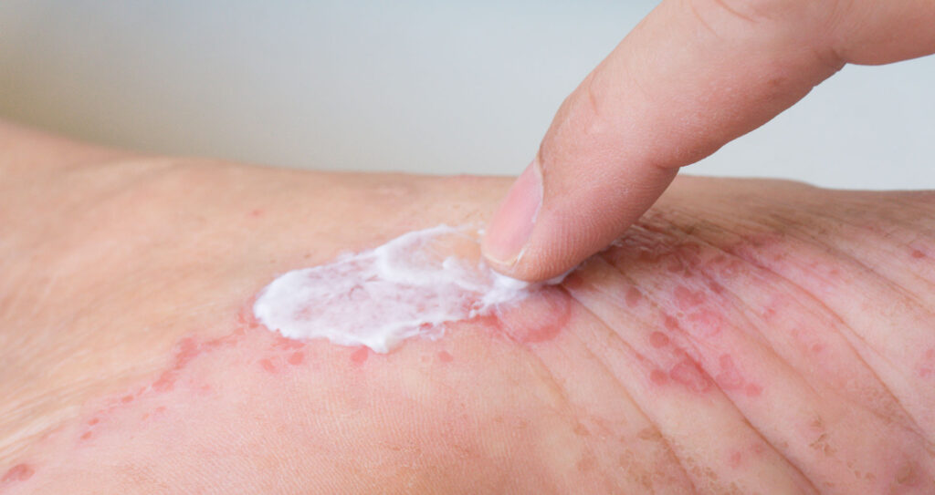 Applying topical steroid ointment to a contact dermatitis skin rash Applying topical steroid ointment to a contact dermatitis skin rash
