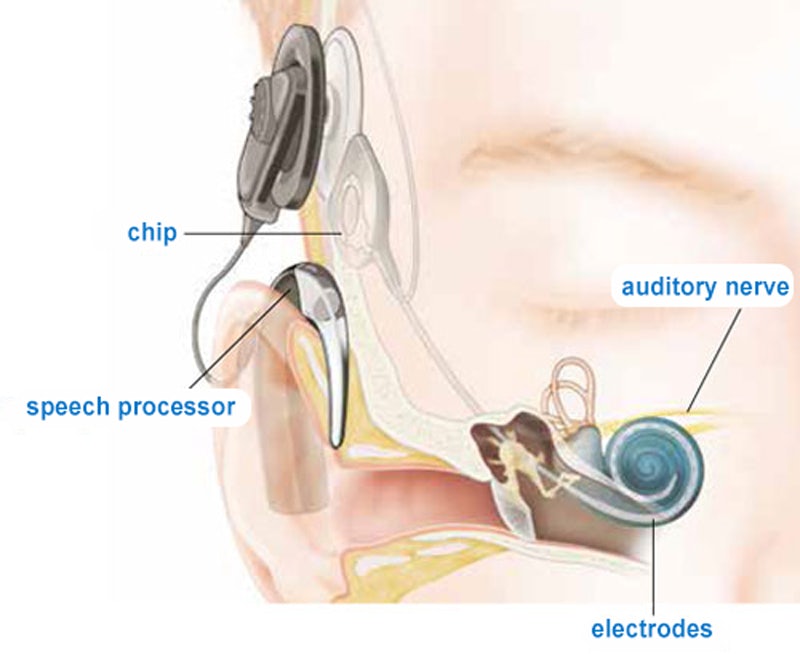 cochlear_implant-en.jpg cochlear_implant-en.jpg