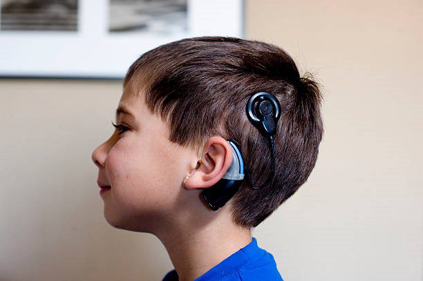 cochlear implants