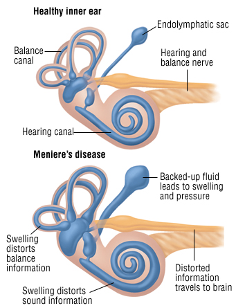 menieres-cochlea-image.jpg menieres-cochlea-image.jpg