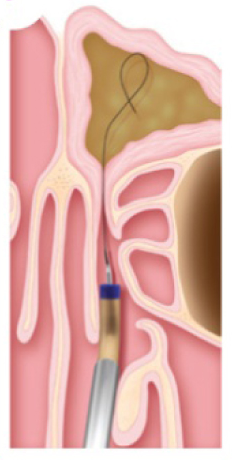 1 Balloon_Sinuplasty.png 1 Balloon_Sinuplasty.png