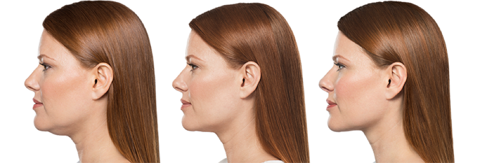 botox 1.png botox 1.png