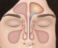 balloon sinuplasty woman
