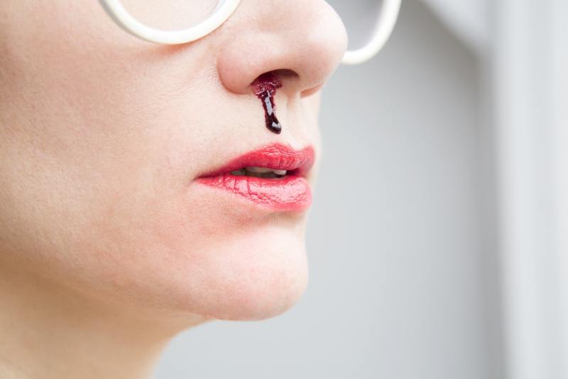 causes and treatments of nose bleeding