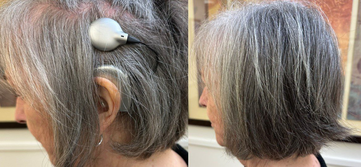 sue coch implant blog pic