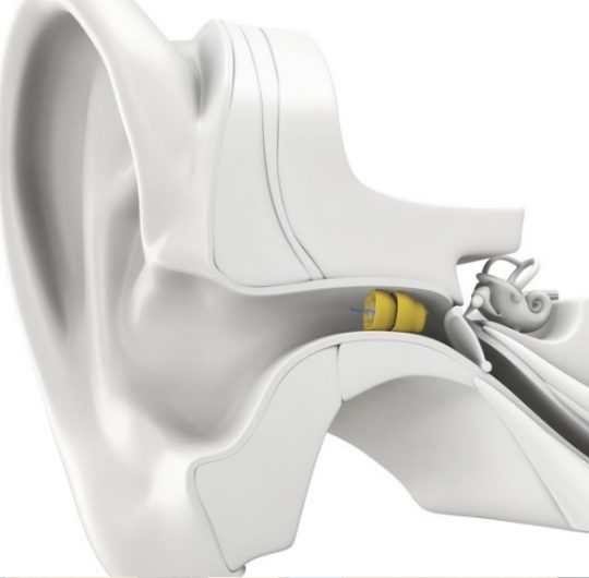 lyric hearing aid@2x